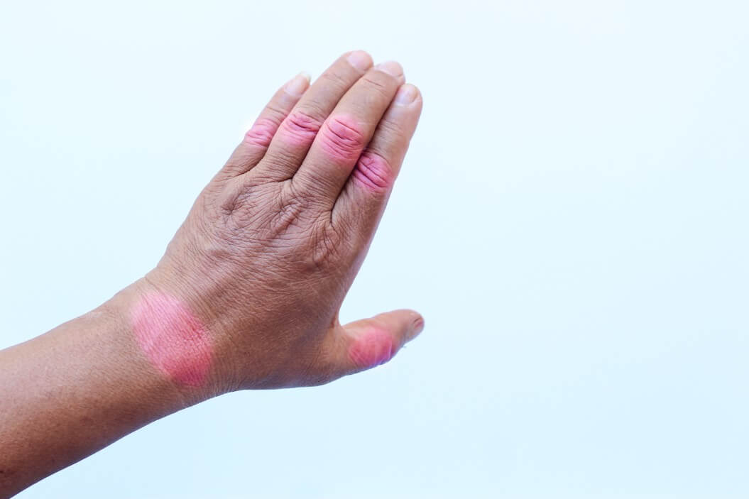 rheumatoid-arthritis-of-hands-isolated-on-white-background_t20_pxZlld (1)